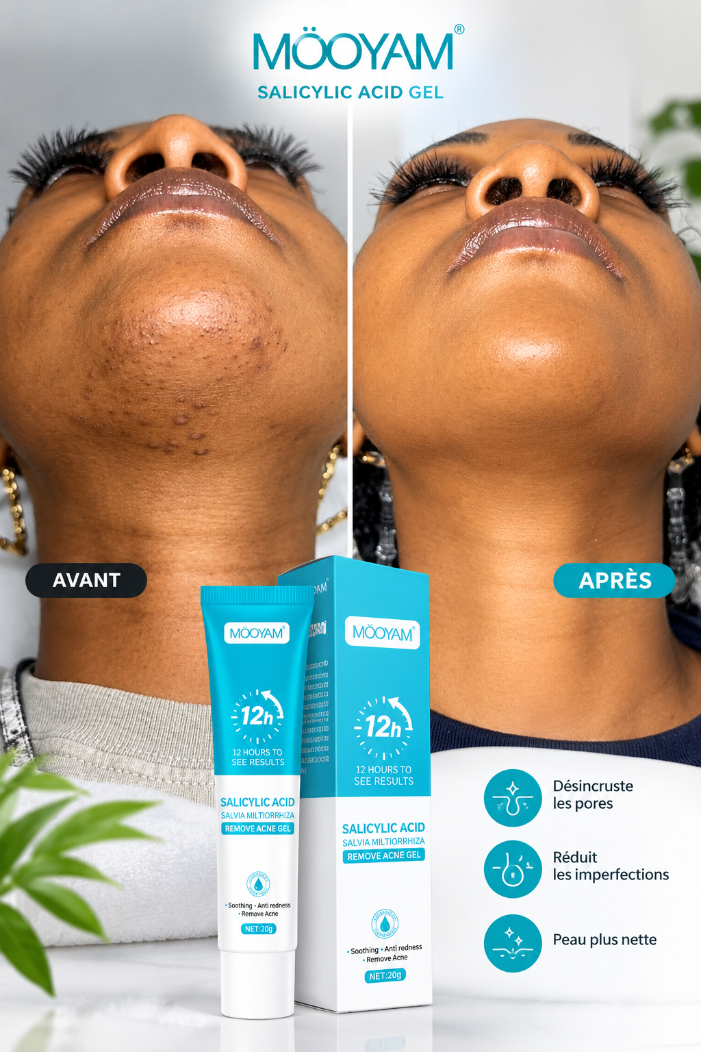 MOoyam Salicylic Acid Gel 20 g